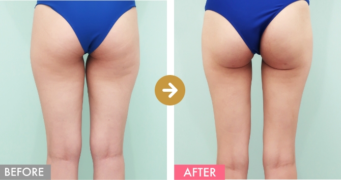 太もも全周＋下臀部の症例写真