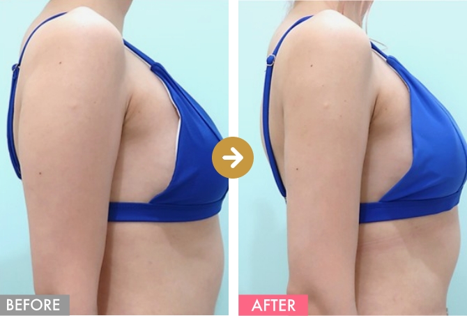 二の腕＋肩＋付け根の症例写真