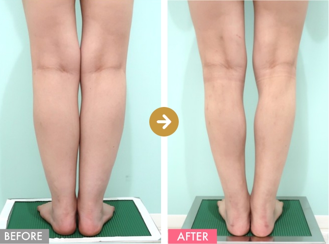 ふくらはぎ＋足首の症例写真