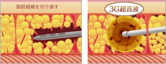 従来の脂肪吸引との違いが分かる画像