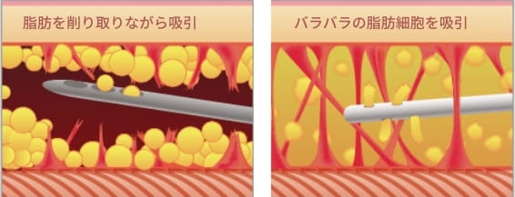 より多くの脂肪除去が可能があるのが分かる画像