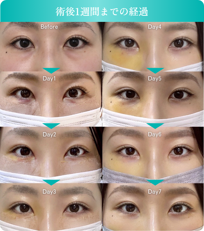 施術後1ヵ月までの経過