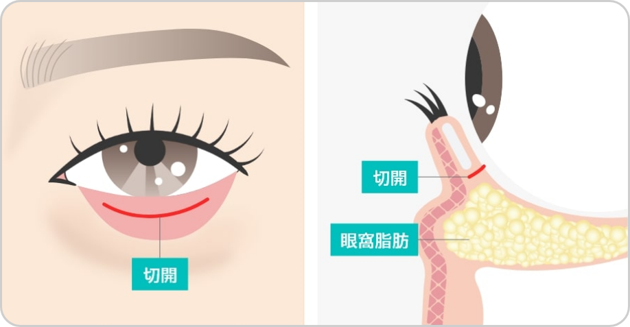 下まぶたの内側を切開＆剥離