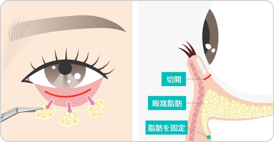 眼窩脂肪の移動