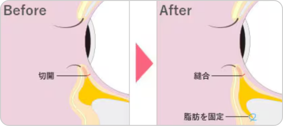 脂肪を縫合して固定する