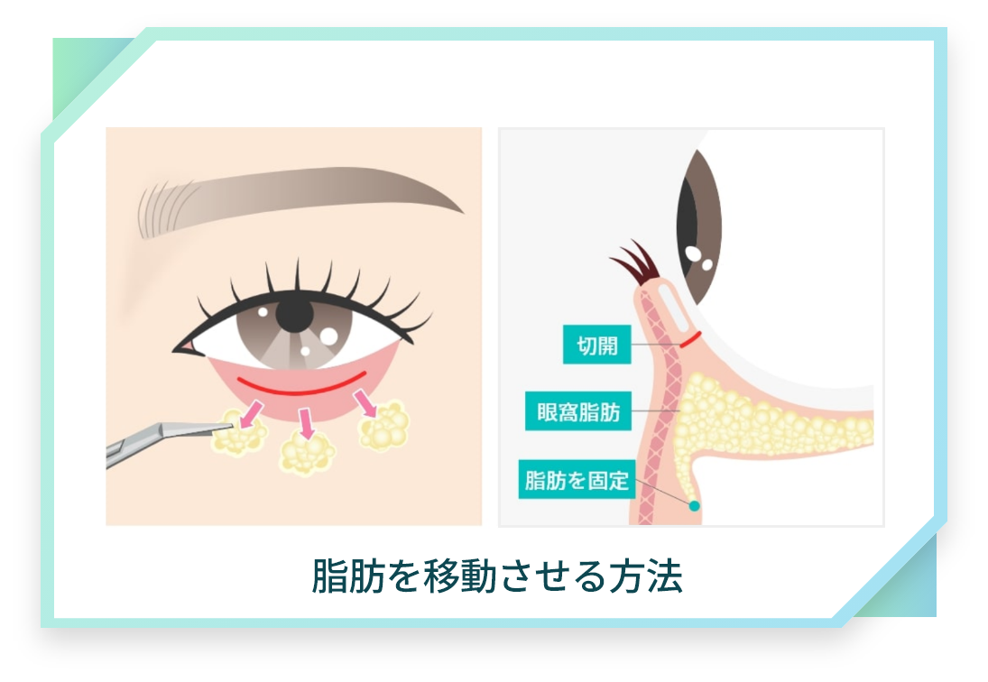 裏ハムラ法とは