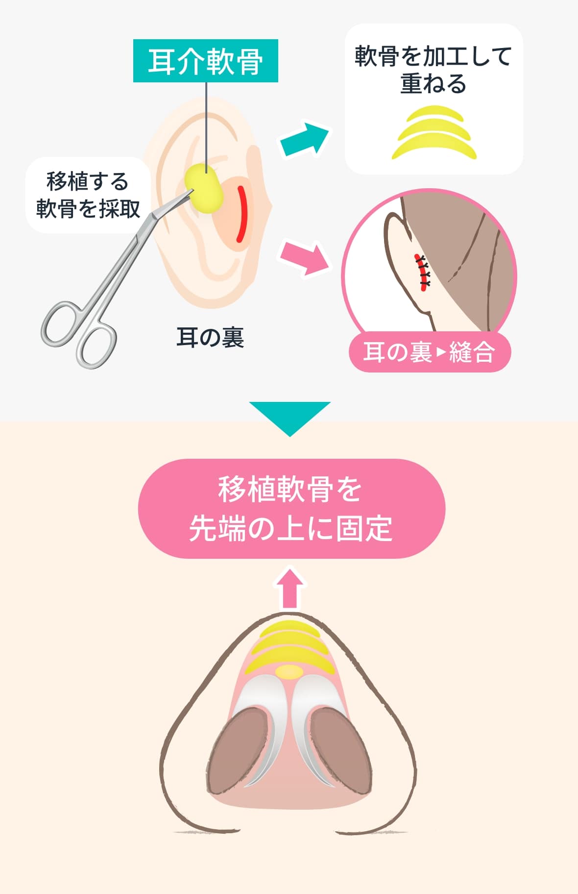 耳介軟骨移植