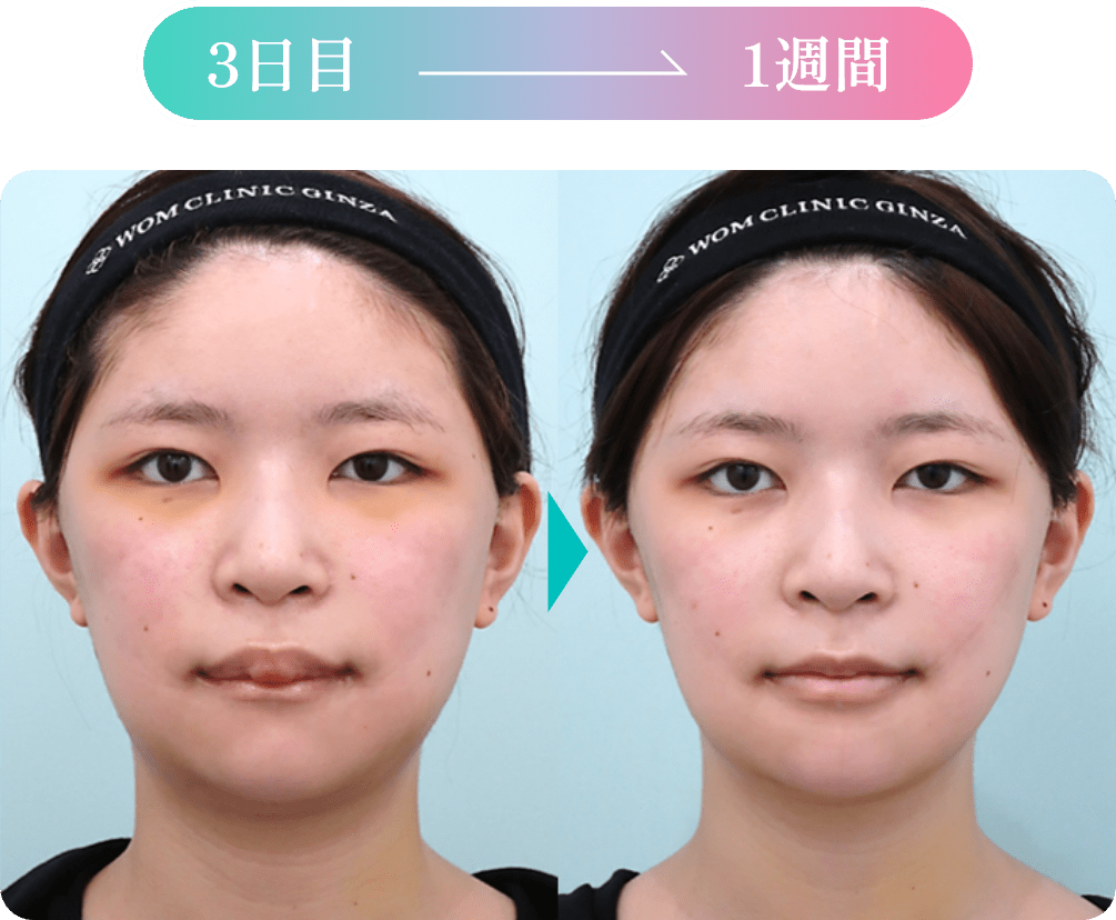 ダウンタイムの経過