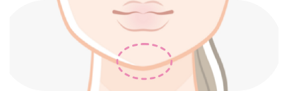 あご(オトガイ)形成