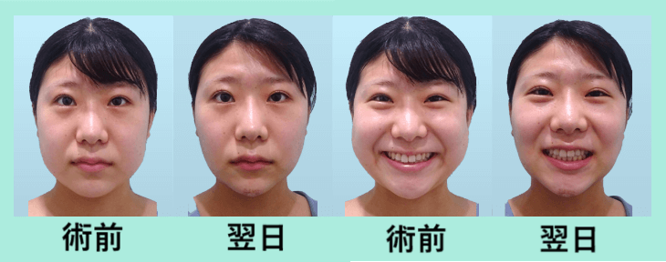 バッカルファット除去 東京 銀座の美容外科クリニックwom Clinic Ginza バッカルファット除去 東京 銀座の美容外科クリニックwom Clinic Ginza