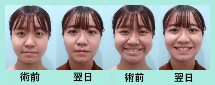 術前 翌日