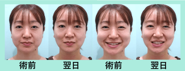 術前 翌日