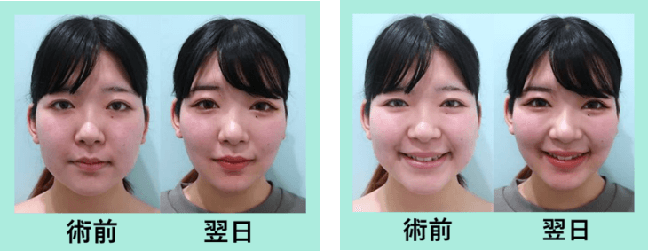 バッカルファット除去 東京 銀座の美容外科クリニックwom Clinic Ginza バッカルファット除去 東京 銀座の美容外科クリニックwom Clinic Ginza