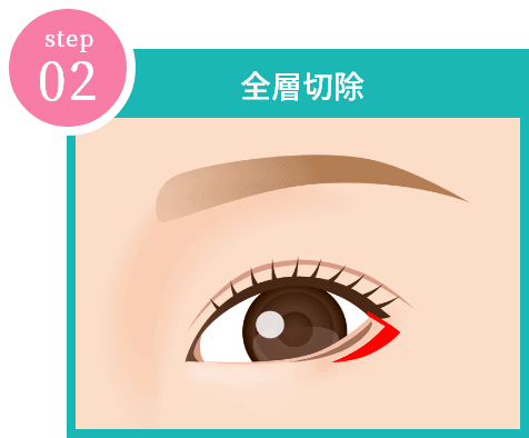 二重 垂れ目形成 東京 銀座の美容外科クリニックwom Clinic Ginza 二重 垂れ目形成 東京 銀座の美容外科クリニックwom Clinic Ginza
