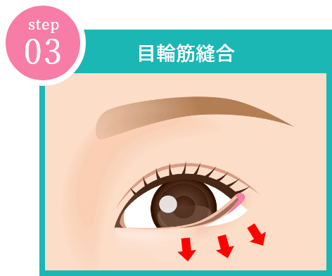 step03 「目輪筋縫」イメージ画像合