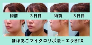 必見 3日目からすごい変化です 小顔マイクロリポ法 東京 銀座の美容外科クリニックwom Clinic Ginza 必見 3日目からすごい変化です 小顔マイクロリポ法 東京 銀座の美容外科クリニックwom Clinic Ginza