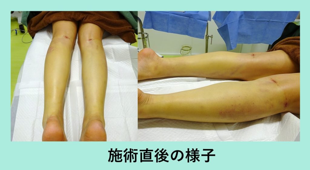内出血 腫れを少なく そして美しく ふくらはぎの脂肪吸引 東京 銀座の美容外科クリニックwom Clinic Ginza 内出血 腫れを少なく そして美しく ふくらはぎの脂肪吸引 東京 銀座の美容外科クリニックwom Clinic Ginza
