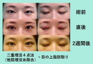 腫れぼったいまぶたには脂肪取りがオススメ 二重埋没4点法 東京 銀座の美容外科クリニックwom Clinic Ginza 腫れぼったいまぶたには脂肪取りがオススメ 二重埋没4点法 東京 銀座の美容外科クリニックwom Clinic Ginza