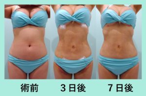 他院では提供できないクオリティと思います お腹の脂肪吸引 東京 銀座の美容外科クリニックwom Clinic Ginza 他院では提供できないクオリティと思います お腹の脂肪吸引 東京 銀座の美容外科クリニックwom Clinic Ginza