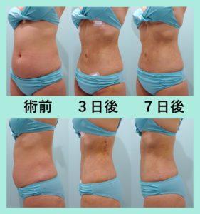 他院では提供できないクオリティと思います お腹の脂肪吸引 東京 銀座の美容外科クリニックwom Clinic Ginza 他院では提供できないクオリティと思います お腹の脂肪吸引 東京 銀座の美容外科クリニックwom Clinic Ginza