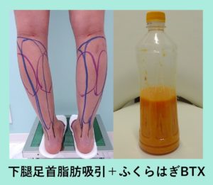 内出血 腫れを少なく そして美しく ふくらはぎの脂肪吸引 東京 銀座の美容外科クリニックwom Clinic Ginza