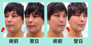 『男性にも人気、施術翌日でも腫れほぼなし！！「小顔組み合わせ治療」』の画像