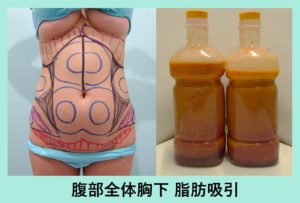 他院では提供できないクオリティと思います お腹の脂肪吸引 東京 銀座の美容外科クリニックwom Clinic Ginza 他院では提供できないクオリティと思います お腹の脂肪吸引 東京 銀座の美容外科クリニックwom Clinic Ginza