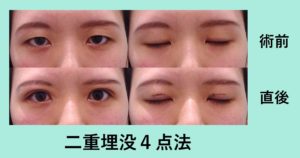 ちょっと待った 本当に眼瞼下垂 二重埋没4点法 東京 銀座の美容外科クリニック Wom Clinic Ginza ちょっと待った 本当に眼瞼下垂 二重埋没4点法 東京 銀座の美容外科クリニック Wom Clinic Ginza