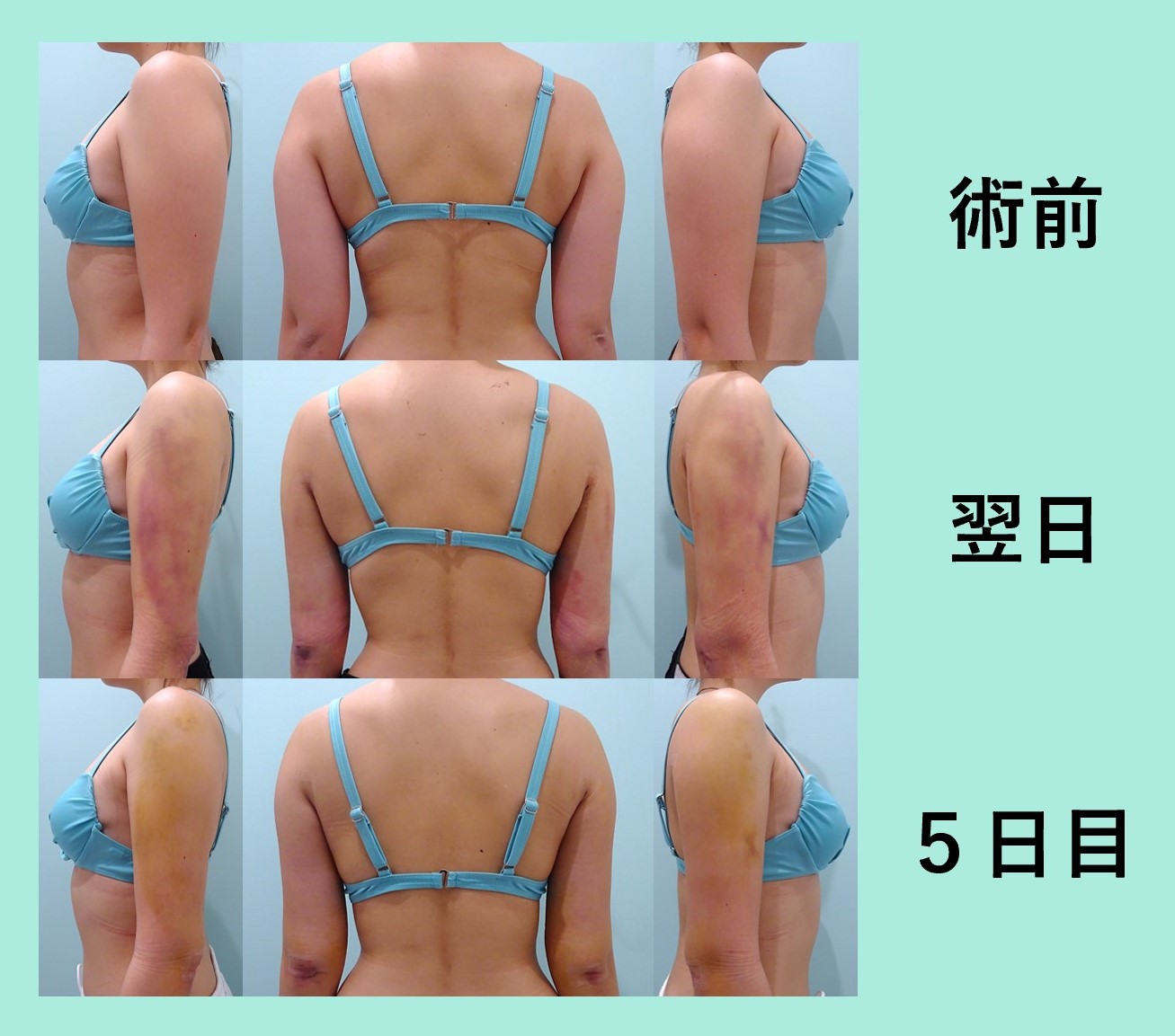 圧倒的にダウンタイムの短い 二の腕肩付け根脂肪吸引 東京 銀座の美容外科クリニックwom Clinic Ginza