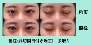 非切開目付き矯正の修正治療 東京 銀座の美容外科クリニック Wom Clinic Ginza 非切開目付き矯正の修正治療 東京 銀座の美容外科クリニック Wom Clinic Ginza