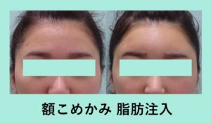余った脂肪はおでこに入れましょう 額crf脂肪注入 東京 銀座の美容外科クリニックwom Clinic Ginza 余った脂肪はおでこに入れましょう 額crf脂肪注入 東京 銀座の美容外科クリニックwom Clinic Ginza