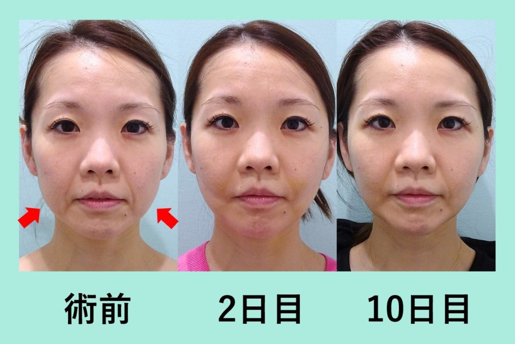 糸リフト単独よりも効果的「小顔組み合わせ治療」 WOMクリニック銀座 糸リフト単独よりも効果的「小顔組み合わせ治療」 WOMクリニック銀座
