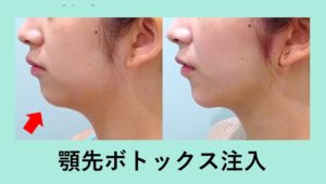 効果抜群 顎先ボトックス 東京 銀座の美容外科クリニックwom Clinic Ginza 効果抜群 顎先ボトックス 東京 銀座の美容外科クリニックwom Clinic Ginza