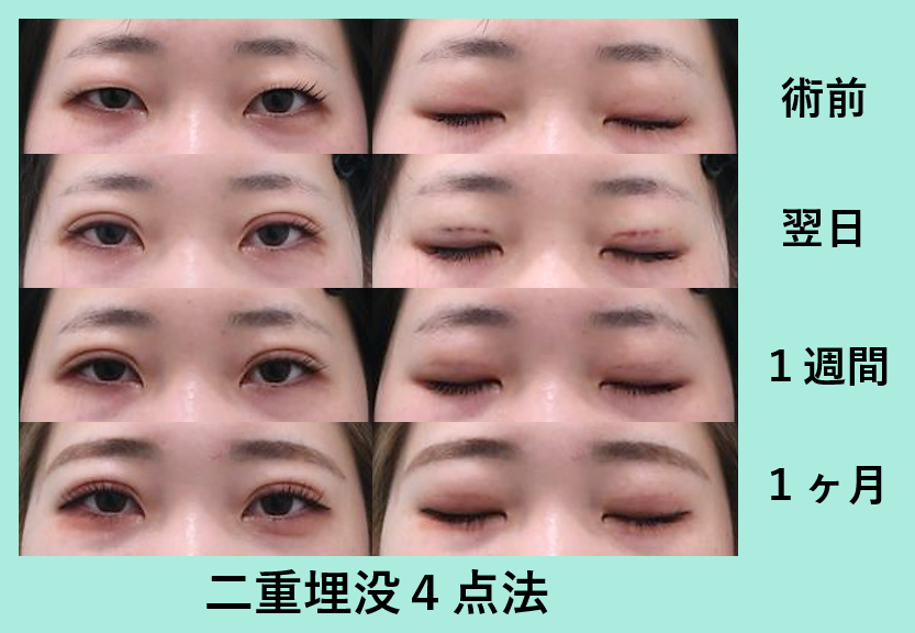 二重埋没4点法_術後1ヶ月ダウンタイム