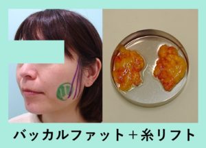 長年悩んでいた下膨れを解消 バッカルファット 糸リフトの組み合わせ治療 東京 銀座の美容外科クリニックwom Clinic Ginza 長年悩んでいた下膨れを解消 バッカルファット 糸リフトの組み合わせ治療 東京 銀座の美容外科クリニックwom Clinic Ginza