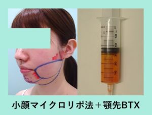 『横顔美人を作る方法「小顔マイクロリポ法＋顎先BTX」』の画像
