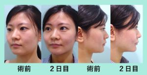 『顔の印象変わります！「小顔組み合わせ治療」』の画像