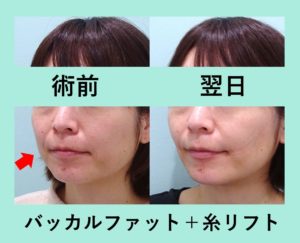 長年悩んでいた下膨れを解消 バッカルファット 糸リフトの組み合わせ治療 東京 銀座の美容外科クリニックwom Clinic Ginza 長年悩んでいた下膨れを解消 バッカルファット 糸リフトの組み合わせ治療 東京 銀座の美容外科クリニックwom Clinic Ginza