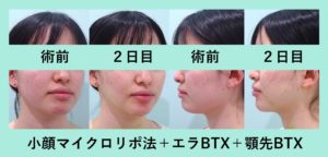 『『エラBTX』『顎先BTX』を組み合わせた「小顔マイクロリポ法」』の画像