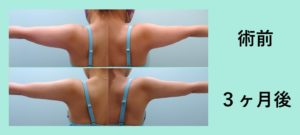 感動のビフォーアフター 二の腕肩付け根の脂肪吸引 東京 銀座の美容外科クリニックwom Clinic Ginza