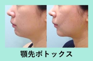 eラインを整える 顎先ボトックス 東京 銀座の美容外科クリニックwom Clinic Ginza