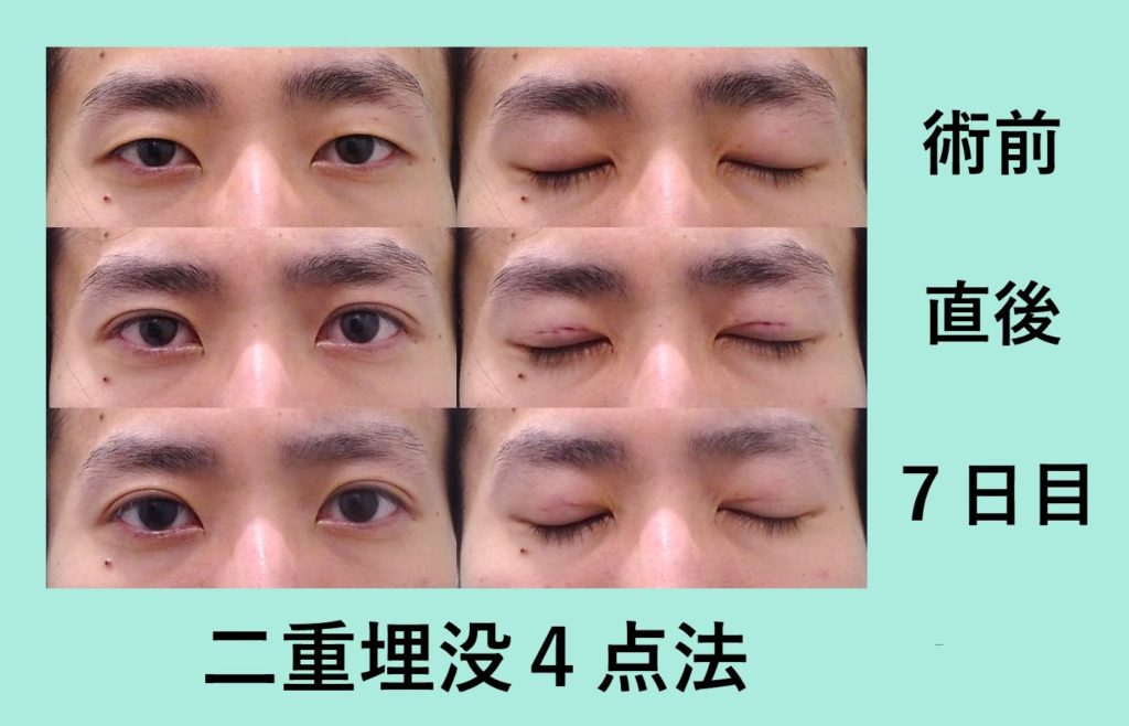 イケメンになりましたね 二重埋没４点法 東京 銀座の美容外科クリニックwom Clinic Ginza