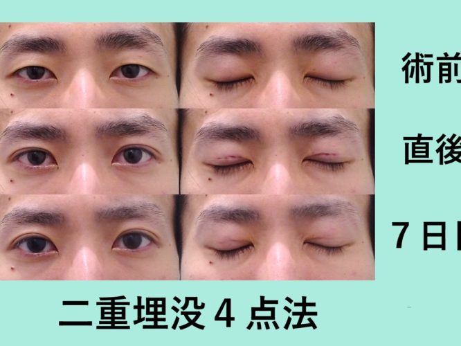 男性 二重 東京 銀座の美容外科クリニックwom Clinic Ginza 男性 二重 東京 銀座の美容外科クリニックwom Clinic Ginza