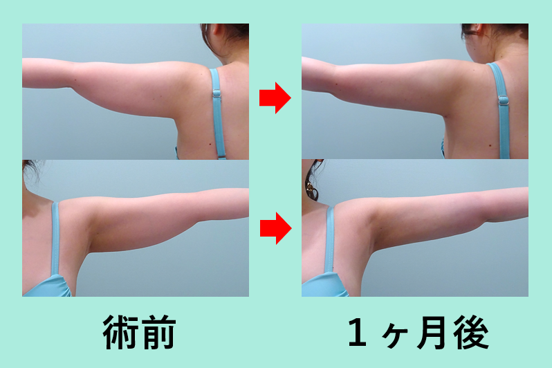 １ｌ越え 今年最高記録 二の腕 肩 付け根の脂肪吸引 東京 銀座の美容外科クリニックwom Clinic Ginza