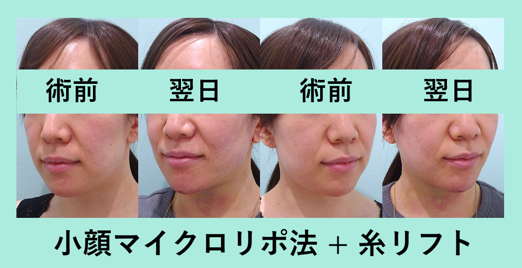 小顔 脂肪吸引 糸リフト ダウンタイム