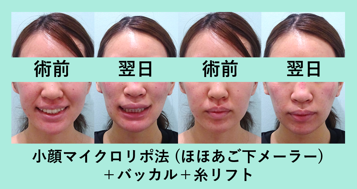 小顔 脂肪吸引 バッカルファット メーラーファット 糸リフト ダウンタイム