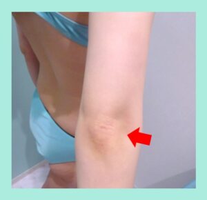 『傷跡目立たず、最小ダウンタイム「二の腕肩付け根の脂肪吸引」』の画像