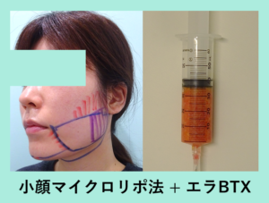 自然な感じで細くする 小顔マイクロリポ法 東京 銀座の美容外科クリニックwom Clinic Ginza