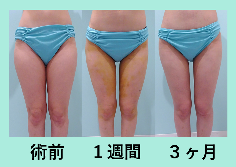 太もも ベイザー脂肪吸引 ビフォーアフター