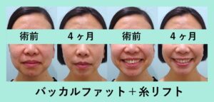 『顔の重心を変える「小顔組み合わせ治療」』の画像